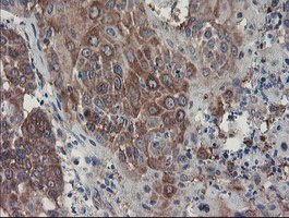 SENP2 Antibody - IHC of paraffin-embedded Carcinoma of Human lung tissue using anti-SENP2 mouse monoclonal antibody. (Heat-induced epitope retrieval by 10mM citric buffer, pH6.0, 100C for 10min).