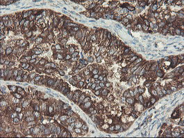 SENP2 Antibody - IHC of paraffin-embedded Adenocarcinoma of Human ovary tissue using anti-SENP2 mouse monoclonal antibody. (Heat-induced epitope retrieval by 10mM citric buffer, pH6.0, 100C for 10min).