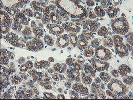 SENP2 Antibody - IHC of paraffin-embedded Carcinoma of Human thyroid tissue using anti-SENP2 mouse monoclonal antibody. (Heat-induced epitope retrieval by 10mM citric buffer, pH6.0, 100C for 10min).