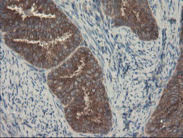 SENP2 Antibody - IHC of paraffin-embedded Adenocarcinoma of Human endometrium tissue using anti-SENP2 mouse monoclonal antibody. (Heat-induced epitope retrieval by 10mM citric buffer, pH6.0, 100C for 10min).