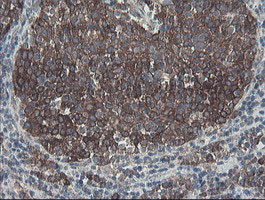 SENP2 Antibody - IHC of paraffin-embedded Carcinoma of Human bladder tissue using anti-SENP2 mouse monoclonal antibody. (Heat-induced epitope retrieval by 10mM citric buffer, pH6.0, 100C for 10min).