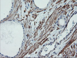 SENP2 Antibody - IHC of paraffin-embedded Carcinoma of Human prostate tissue using anti-SENP2 mouse monoclonal antibody.