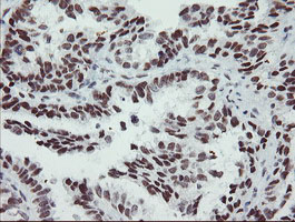 SENP2 Antibody - IHC of paraffin-embedded Adenocarcinoma of Human ovary tissue using anti-SENP2 mouse monoclonal antibody.