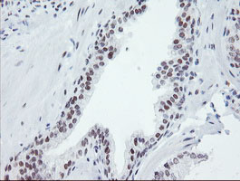 SENP2 Antibody - IHC of paraffin-embedded Carcinoma of Human prostate tissue using anti-SENP2 mouse monoclonal antibody.