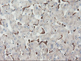 SENP2 Antibody - IHC of paraffin-embedded Carcinoma of Human liver tissue using anti-SENP2 mouse monoclonal antibody. (Heat-induced epitope retrieval by 10mM citric buffer, pH6.0, 100C for 10min).