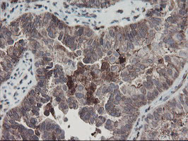 SENP2 Antibody - IHC of paraffin-embedded Adenocarcinoma of Human ovary tissue using anti-SENP2 mouse monoclonal antibody. (Heat-induced epitope retrieval by 10mM citric buffer, pH6.0, 100C for 10min).