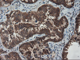 SENP2 Antibody - IHC of paraffin-embedded Adenocarcinoma of Human ovary tissue using anti-SENP2 mouse monoclonal antibody. (Heat-induced epitope retrieval by 10mM citric buffer, pH6.0, 100C for 10min).