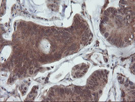 SENP2 Antibody - IHC of paraffin-embedded Carcinoma of Human pancreas tissue using anti-SENP2 mouse monoclonal antibody. (Heat-induced epitope retrieval by 10mM citric buffer, pH6.0, 100C for 10min).