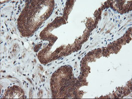 SENP2 Antibody - IHC of paraffin-embedded Carcinoma of Human prostate tissue using anti-SENP2 mouse monoclonal antibody. (Heat-induced epitope retrieval by 10mM citric buffer, pH6.0, 100C for 10min).