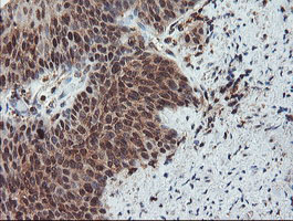 SENP2 Antibody - IHC of paraffin-embedded Carcinoma of Human bladder tissue using anti-SENP2 mouse monoclonal antibody. (Heat-induced epitope retrieval by 10mM citric buffer, pH6.0, 100C for 10min).