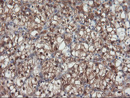 SENP2 Antibody - IHC of paraffin-embedded Carcinoma of Human kidney tissue using anti-SENP2 mouse monoclonal antibody. (Heat-induced epitope retrieval by 10mM citric buffer, pH6.0, 100C for 10min).