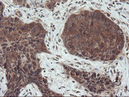 SENP2 Antibody - IHC of paraffin-embedded Carcinoma of Human lung tissue using anti-SENP2 mouse monoclonal antibody. (Heat-induced epitope retrieval by 10mM citric buffer, pH6.0, 100C for 10min).