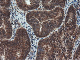 SENP2 Antibody - IHC of paraffin-embedded Adenocarcinoma of Human endometrium tissue using anti-SENP2 mouse monoclonal antibody. (Heat-induced epitope retrieval by 10mM citric buffer, pH6.0, 100C for 10min).