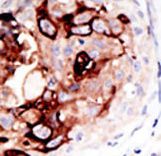 SENP2 Antibody - Formalin-fixed and paraffin-embedded human cancer tissue reacted with the primary antibody, which was peroxidase-conjugated to the secondary antibody, followed by AEC staining. This data demonstrates the use of this antibody for immunohistochemistry; clinical relevance has not been evaluated. BC = breast carcinoma; HC = hepatocarcinoma.