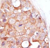 SENP2 Antibody - Formalin-fixed and paraffin-embedded human cancer tissue reacted with the primary antibody, which was peroxidase-conjugated to the secondary antibody, followed by DAB staining. This data demonstrates the use of this antibody for immunohistochemistry; clinical relevance has not been evaluated. BC = breast carcinoma; HC = hepatocarcinoma.