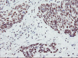 SENP2 Antibody - IHC of paraffin-embedded Carcinoma of Human lung tissue using anti-SENP2 mouse monoclonal antibody.