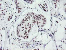 SENP2 Antibody - IHC of paraffin-embedded Carcinoma of Human pancreas tissue using anti-SENP2 mouse monoclonal antibody.