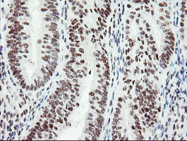 SENP2 Antibody - IHC of paraffin-embedded Adenocarcinoma of Human endometrium tissue using anti-SENP2 mouse monoclonal antibody.