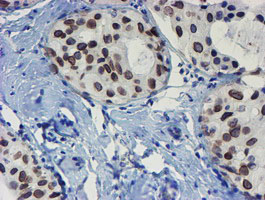 SENP2 Antibody - IHC of paraffin-embedded Adenocarcinoma of Human breast tissue using anti-SENP2 mouse monoclonal antibody.