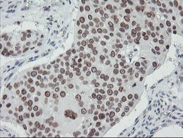 SENP2 Antibody - IHC of paraffin-embedded Carcinoma of Human lung tissue using anti-SENP2 mouse monoclonal antibody.