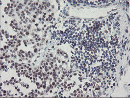 SENP2 Antibody - IHC of paraffin-embedded Carcinoma of Human bladder tissue using anti-SENP2 mouse monoclonal antibody.