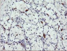 SENP2 Antibody - IHC of paraffin-embedded Carcinoma of Human kidney tissue using anti-SENP2 mouse monoclonal antibody.