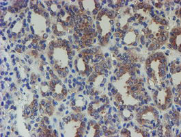 SENP2 Antibody - IHC of paraffin-embedded Carcinoma of Human thyroid tissue using anti-SENP2 mouse monoclonal antibody.