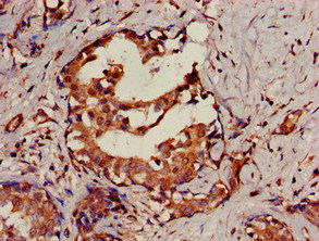 SENP2 Antibody - Immunohistochemistry image of paraffin-embedded human breast cancer at a dilution of 1:100