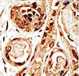 SENP3 Antibody - Formalin-fixed and paraffin-embedded human cancer tissue reacted with the primary antibody, which was peroxidase-conjugated to the secondary antibody, followed by AEC staining. This data demonstrates the use of this antibody for immunohistochemistry; clinical relevance has not been evaluated. BC = breast carcinoma; HC = hepatocarcinoma.