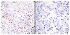 SENP3 Antibody - Immunohistochemistry analysis of paraffin-embedded human breast carcinoma tissue, using SENP3 Antibody. The picture on the right is blocked with the synthesized peptide.