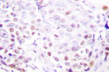 SENP3 Antibody - IHC of SENP3 (Y24) pAb in paraffin-embedded human breast carcinoma tissue.