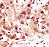 SENP5 Antibody - Formalin-fixed and paraffin-embedded human cancer tissue reacted with the primary antibody, which was peroxidase-conjugated to the secondary antibody, followed by DAB staining. This data demonstrates the use of this antibody for immunohistochemistry; clinical relevance has not been evaluated. BC = breast carcinoma; HC = hepatocarcinoma.
