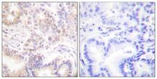 SENP5 Antibody - Immunohistochemistry analysis of paraffin-embedded human lung carcinoma tissue, using SENP5 Antibody. The picture on the right is blocked with the synthesized peptide.
