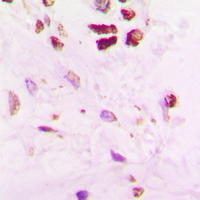 SENP5 Antibody - Immunohistochemical analysis of SENP5 staining in human lung cancer formalin fixed paraffin embedded tissue section. The section was pre-treated using heat mediated antigen retrieval with sodium citrate buffer (pH 6.0). The section was then incubated with the antibody at room temperature and detected using an HRP conjugated compact polymer system. DAB was used as the chromogen. The section was then counterstained with hematoxylin and mounted with DPX.