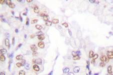 SENP5 Antibody - IHC of SENP5 (L681) pAb in paraffin-embedded human lung carcinoma tissue.
