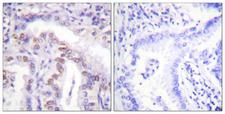 SENP6 Antibody - Immunohistochemistry analysis of paraffin-embedded human lung carcinoma, using SENP6 Antibody. The picture on the right is blocked with the synthesized peptide.