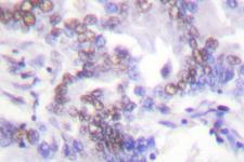 SENP6 Antibody - IHC of SENP6 (K1077) pAb in paraffin-embedded human lung carcinoma tissue.
