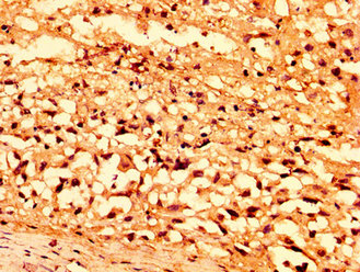 SENP7 Antibody - Immunohistochemistry image at a dilution of 1:500 and staining in paraffin-embedded human melanoma cancer performed on a Leica BondTM system. After dewaxing and hydration, antigen retrieval was mediated by high pressure in a citrate buffer (pH 6.0) . Section was blocked with 10% normal goat serum 30min at RT. Then primary antibody (1% BSA) was incubated at 4 °C overnight. The primary is detected by a biotinylated secondary antibody and visualized using an HRP conjugated SP system.