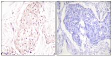 SENP8 Antibody - Peptide - + Immunohistochemistry analysis of paraffin-embedded human breast carcinoma tissue using SENP8 antibody.