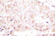 SENP8 Antibody - IHC of SENP8 (T191) pAb in paraffin-embedded human breast carcinoma tissue.