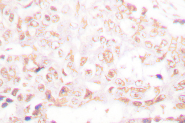 SENP8 Antibody - IHC of SENP8 (T191) pAb in paraffin-embedded human breast carcinoma tissue.