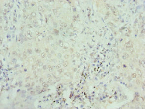 SEPHS1 / SPS Antibody - Immunohistochemistry of paraffin-embedded human lung cancer at dilution 1:100