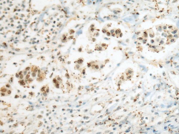 SEPHS1 / SPS Antibody - Immunohistochemistry of paraffin-embedded Human breast cancer tissue  using SEPHS1 Polyclonal Antibody at dilution of 1:80(×200)