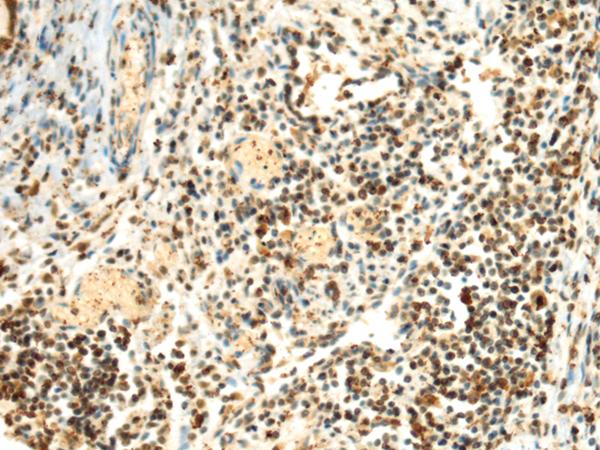 SEPHS1 / SPS Antibody - Immunohistochemistry of paraffin-embedded Human lung cancer tissue  using SEPHS1 Polyclonal Antibody at dilution of 1:85(×200)