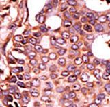 SEPHS2 Antibody - Formalin-fixed and paraffin-embedded human cancer tissue reacted with the primary antibody, which was peroxidase-conjugated to the secondary antibody, followed by DAB staining. This data demonstrates the use of this antibody for immunohistochemistry; clinical relevance has not been evaluated. BC = breast carcinoma; HC = hepatocarcinoma.
