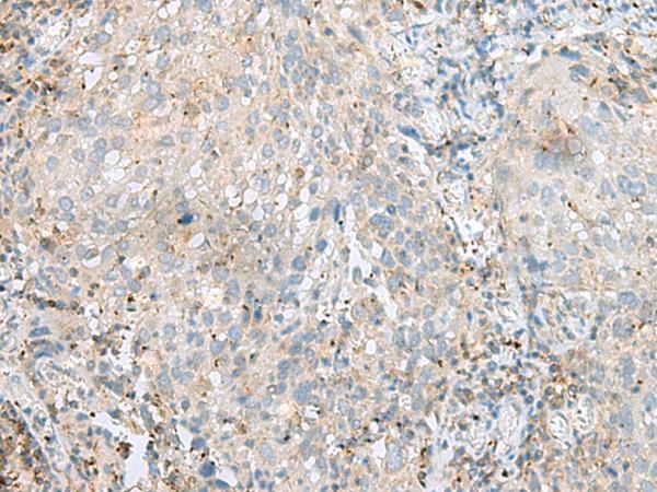 SEPT1 / Septin 1 Antibody - Immunohistochemistry of paraffin-embedded Human cervical cancer tissue  using SEPT1 Polyclonal Antibody at dilution of 1:60(×200)