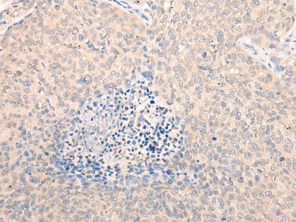 SEPT10 /Septin 10 Antibody - Immunohistochemistry of paraffin-embedded Human cervical cancer tissue  using SEPT10 Polyclonal Antibody at dilution of 1:25(×200)