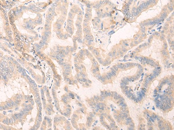 SEPT10 /Septin 10 Antibody - Immunohistochemistry of paraffin-embedded Human thyroid cancer tissue  using SEPT10 Polyclonal Antibody at dilution of 1:25(×200)