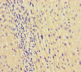 SEPT2 / Septin 2 Antibody - Immunohistochemistry of paraffin-embedded human liver cancer using SEPT2 Antibody at dilution of 1:100