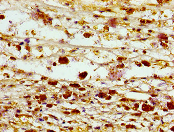 SEPT3 / Septin 3 Antibody - Immunohistochemistry image of paraffin-embedded human melanoma cancer at a dilution of 1:100